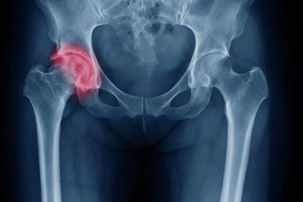 Total Hip Replacement: How Home-Based Physiotherapy Restores Mobility and Quality of Life