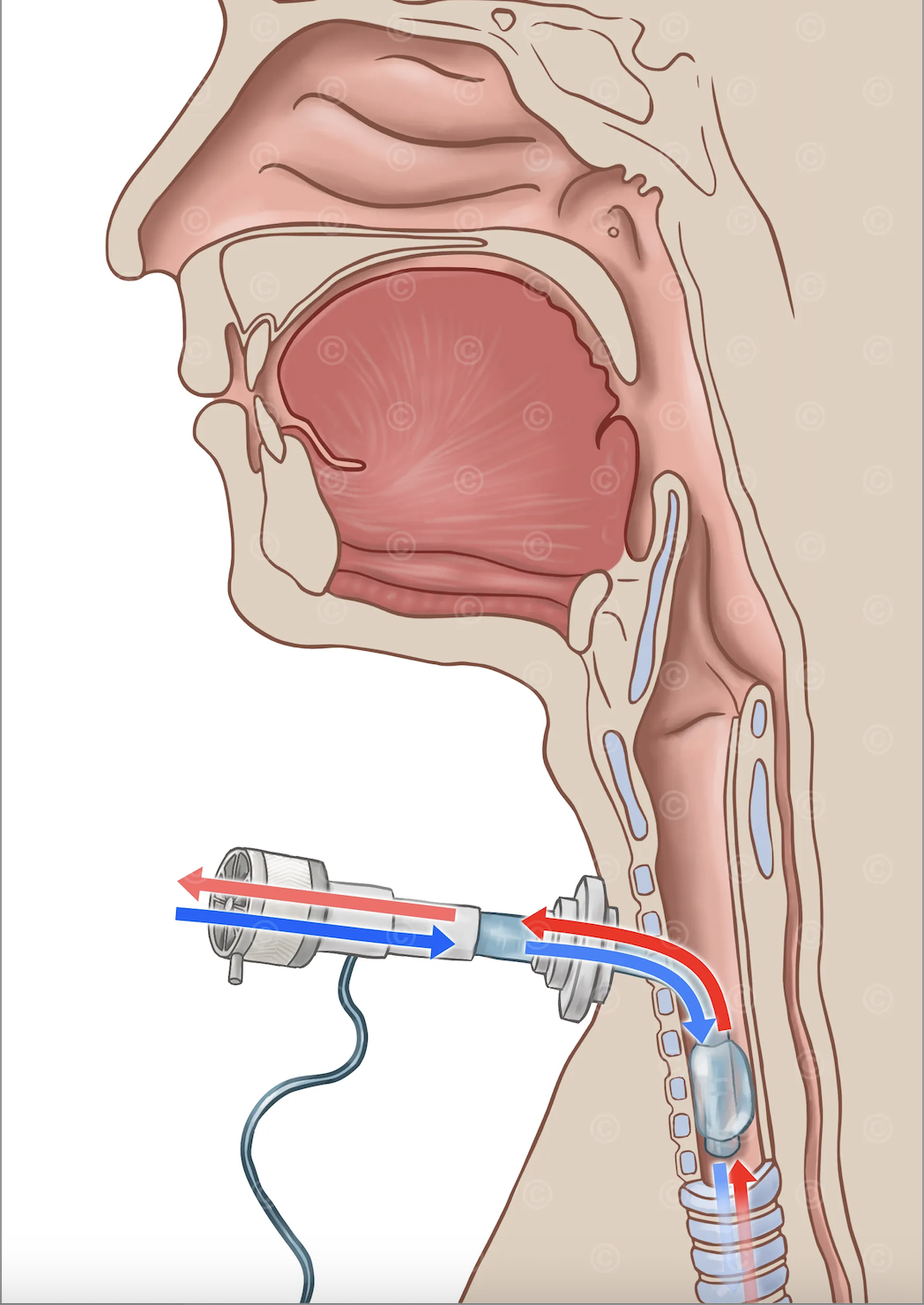 Physiotherapy and Clients with Tracheostomies
