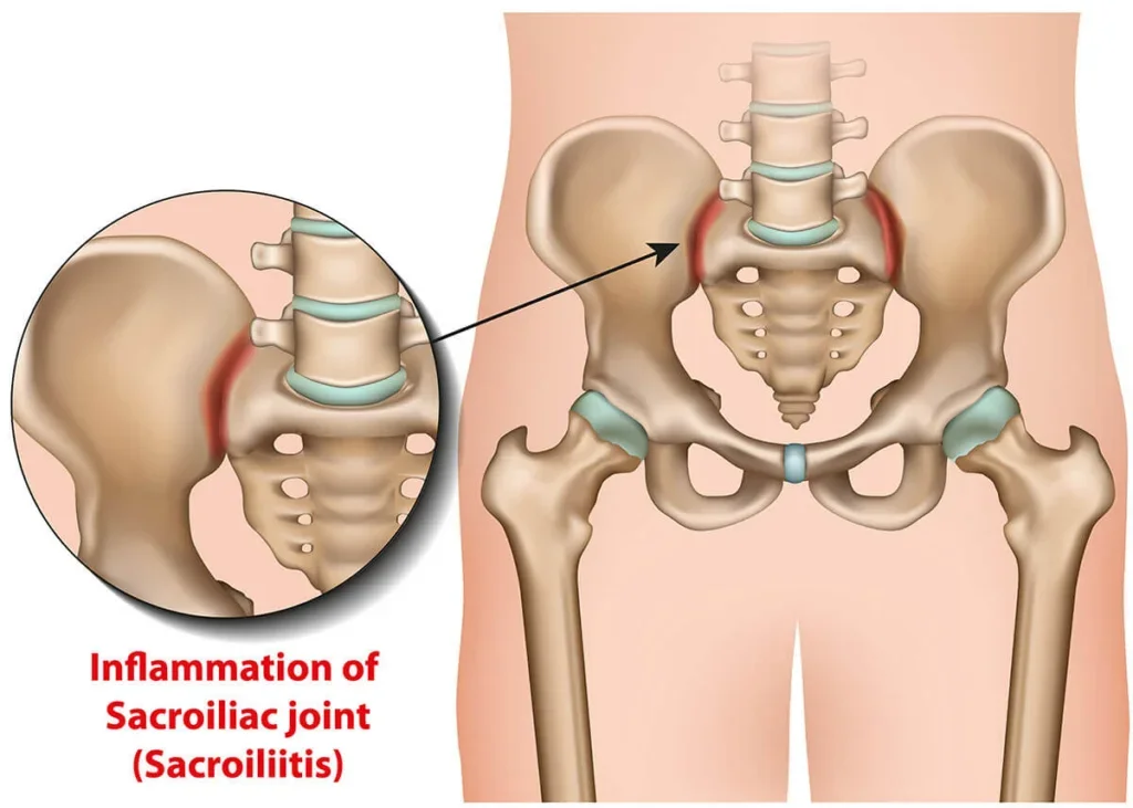 Physiotherapy and Sacroiliac Joint (SIJ) Pain: Restoring Stability and Reducing Discomfort