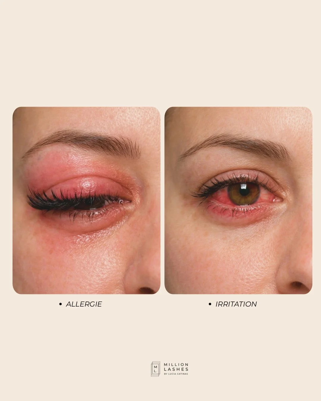 Allergie ou simple irritation ? Les signes, le bon protocole et quand dire non