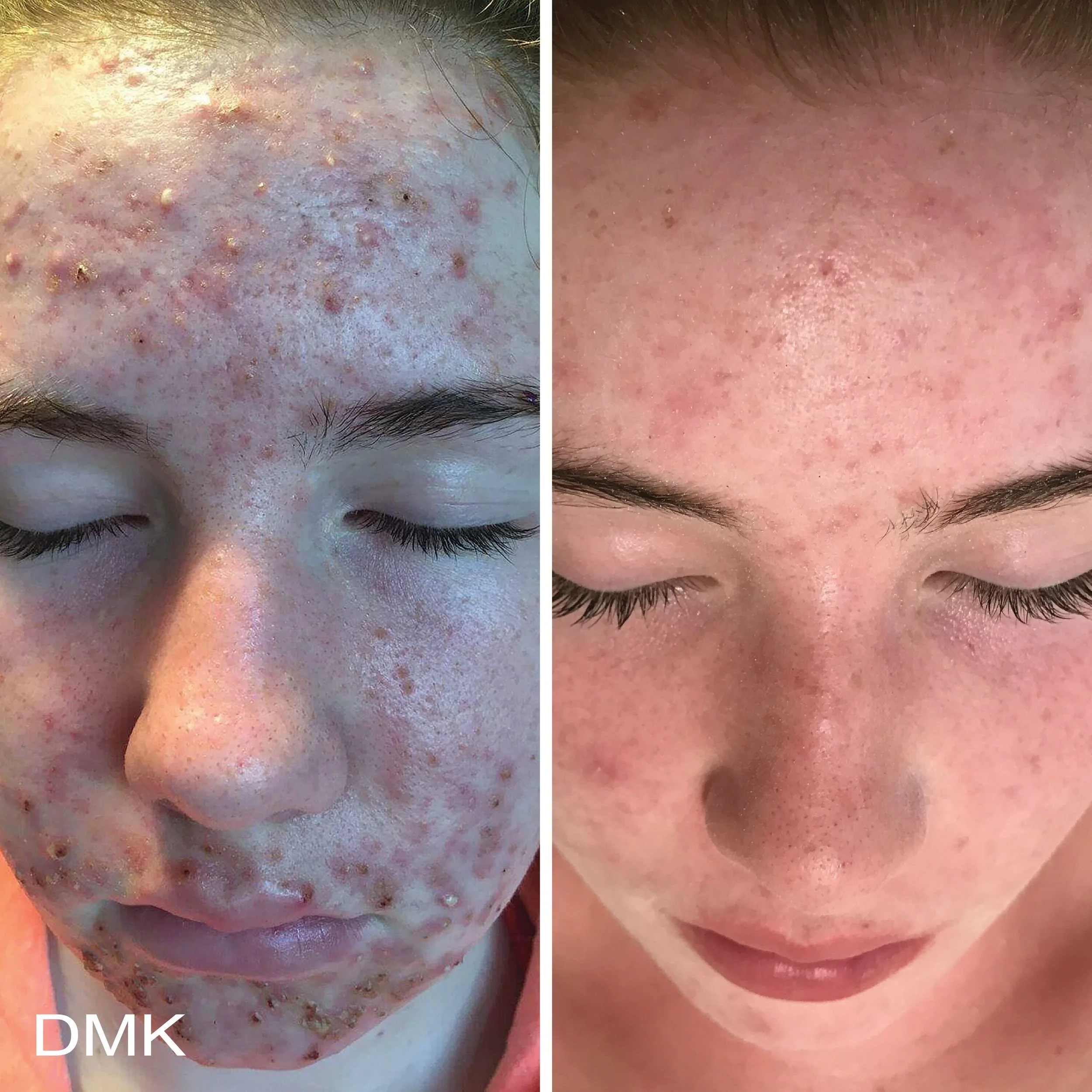 1237353203MyDMKBrandedBeforeandAfterImageryAcne3300dpi-large.jpg
