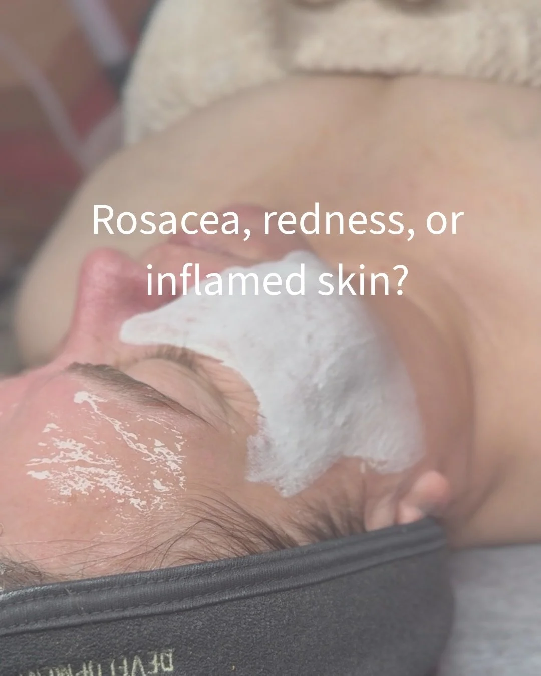 Rosacea and inflamed skin isn&rsquo;t just &ldquo;sensitive skin&rdquo;&hellip; it&rsquo;s skin that&rsquo;s functioning under stress.

One of the biggest mistakes I see?
Only treating the surface.

DMK Alkaline Wash works differently.
It helps softe