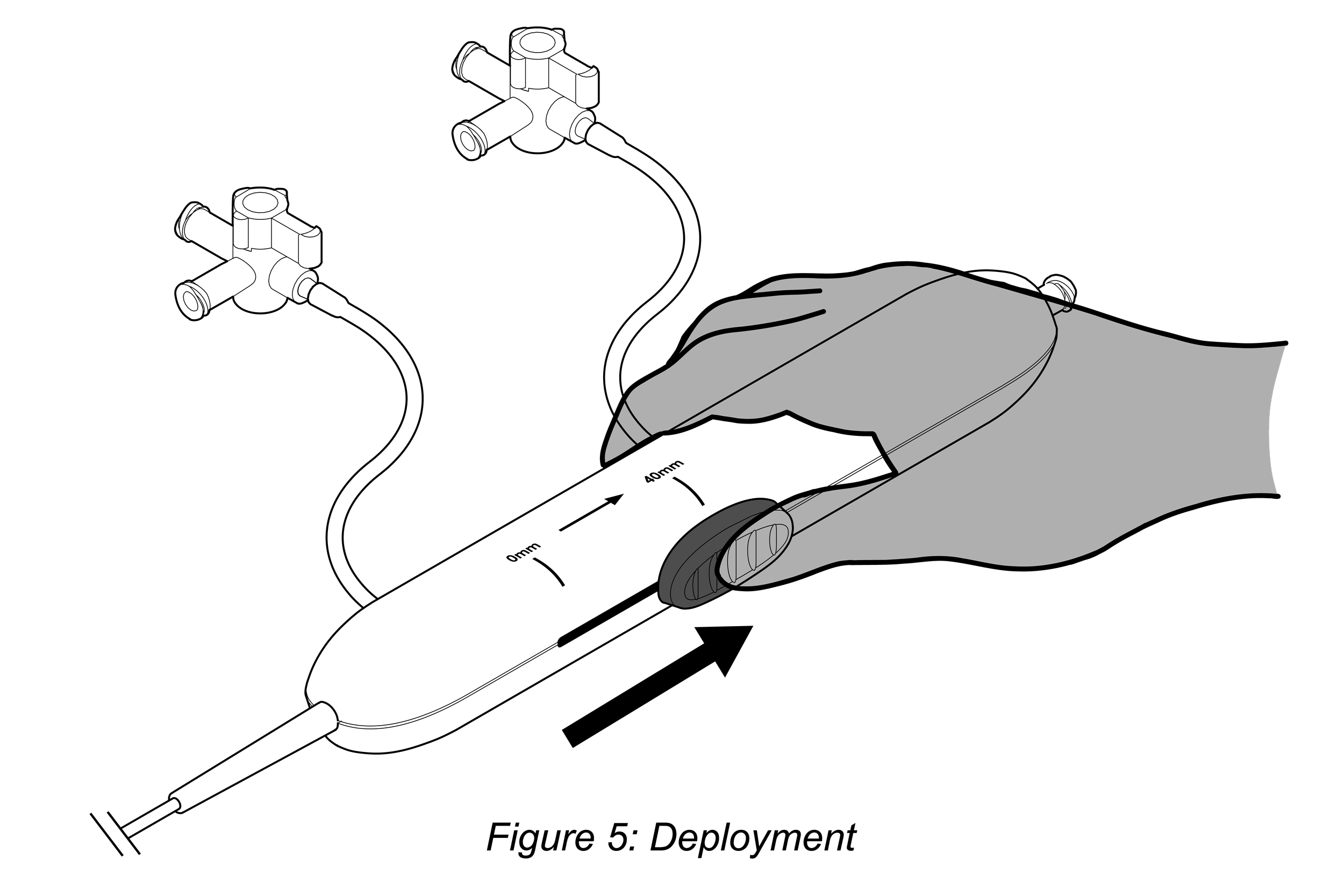 IFU-style technical illustration showing hand actuation of a catheter handle slider