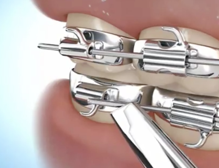 Close-up of a person's mouth with dental braces and a dental tool adjusting the braces.