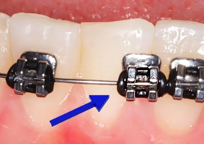 Close-up of teeth with braces, showing a metal wire and brackets. An blue arrow points to the area between two teeth.