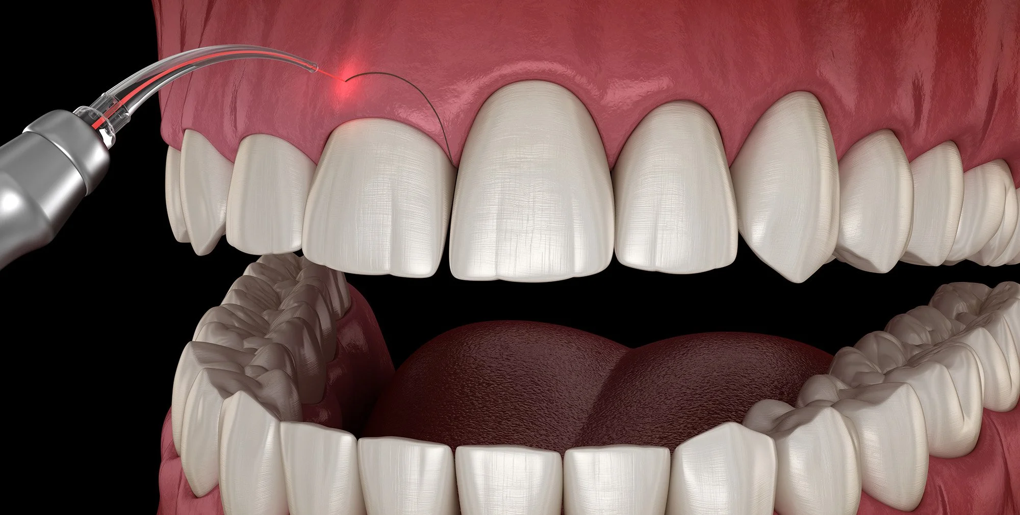 gingivectomy.jpg