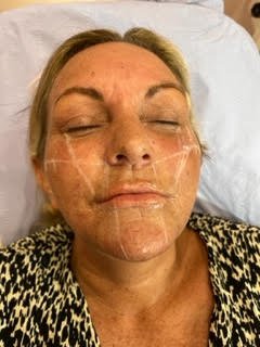Before Full Dermal Filler Package