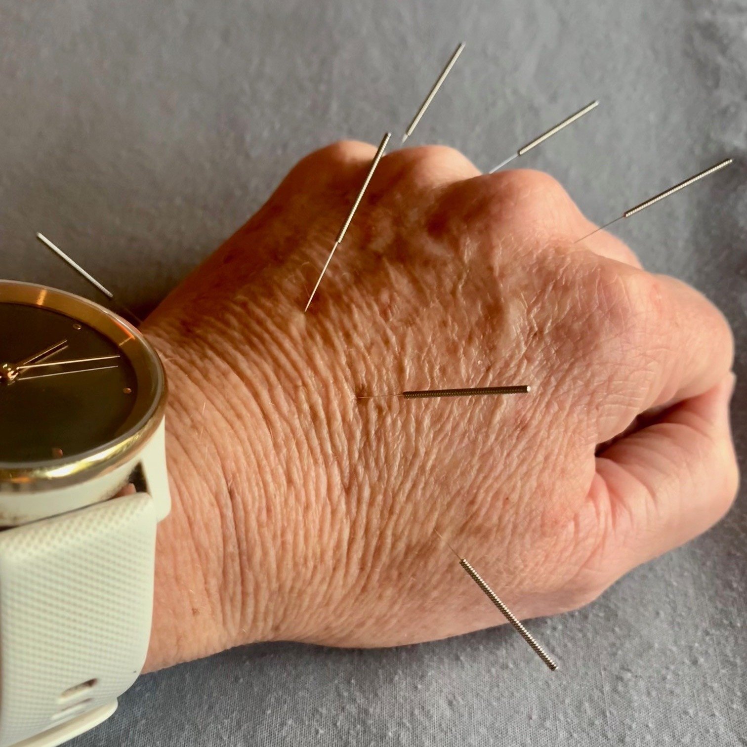 // Master Tung Million Dollar Lower Back Treatment //

Feeling a bit like Wolverine 🐺  A challenging treatment to receive with so many pins placed in the sensitive areas of the hand, but super powerful!

The Master Tung system considers the body as 