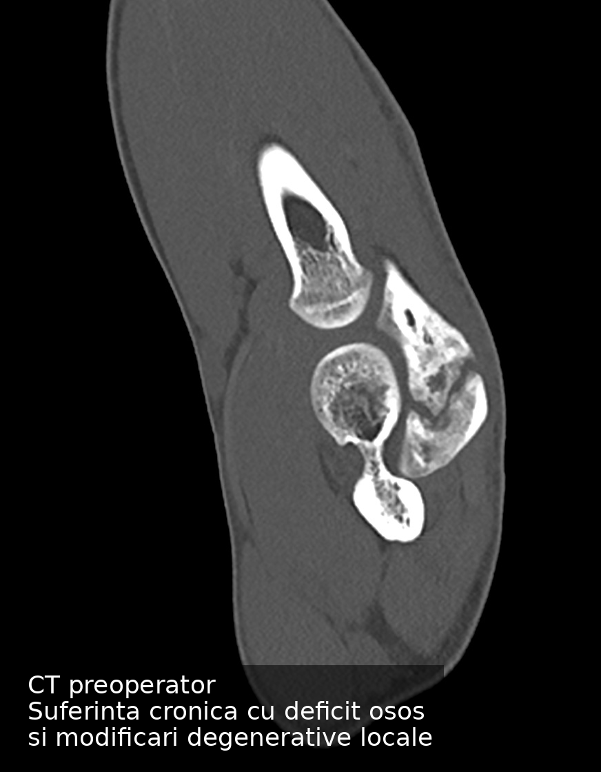 Decizia chirurgicală în patologia cotului la sportivii tineri: când soluția personalizată face diferența