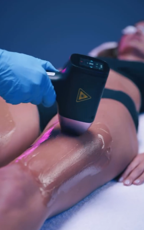 Gros plan sur une séance d'épilation laser des jambes : une praticienne utilise une pièce à main laser sur la peau d'une cliente. Illustration des soins proposés chez Eminails à Waremme, près de Liège