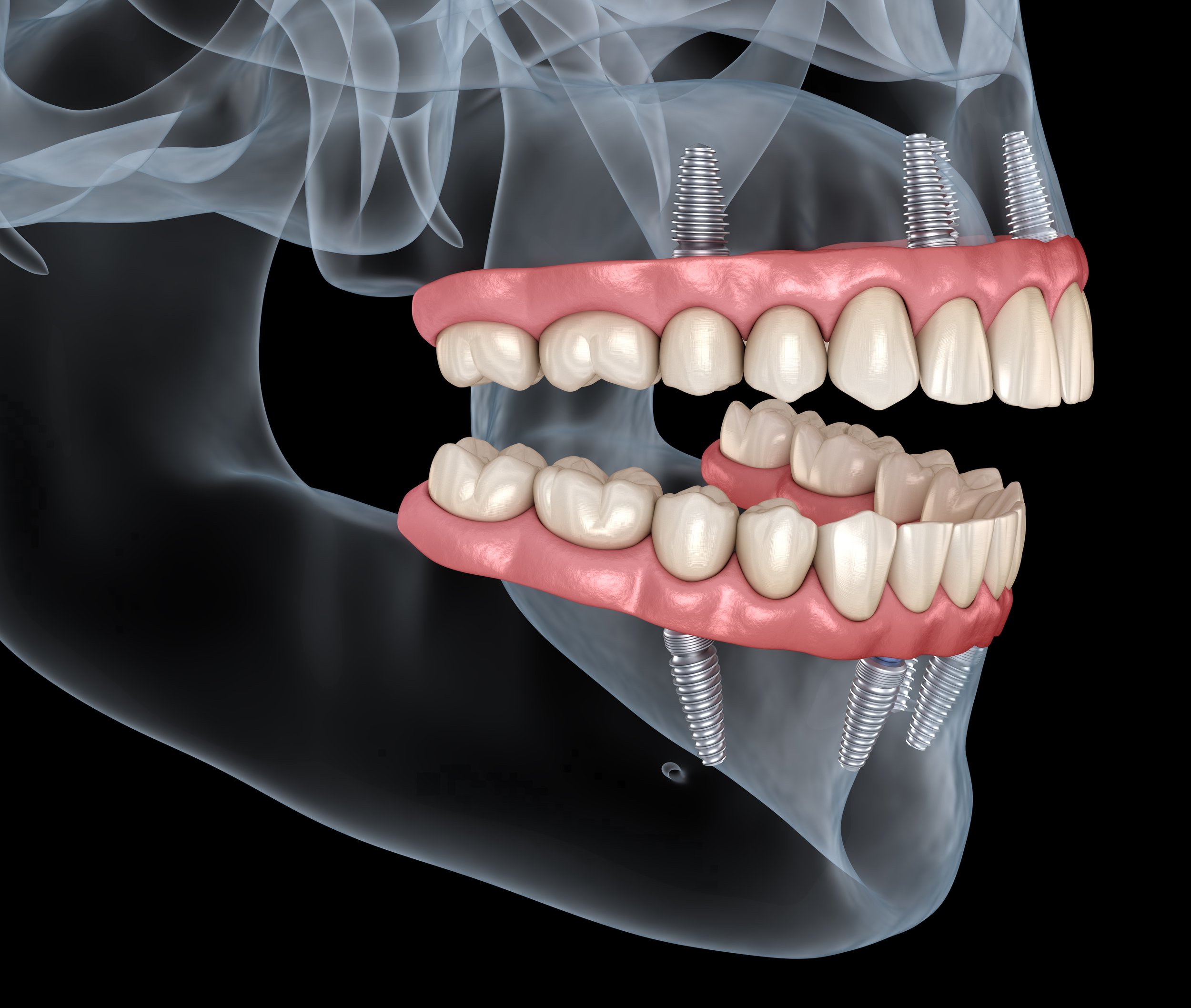 Implant Supported Denture