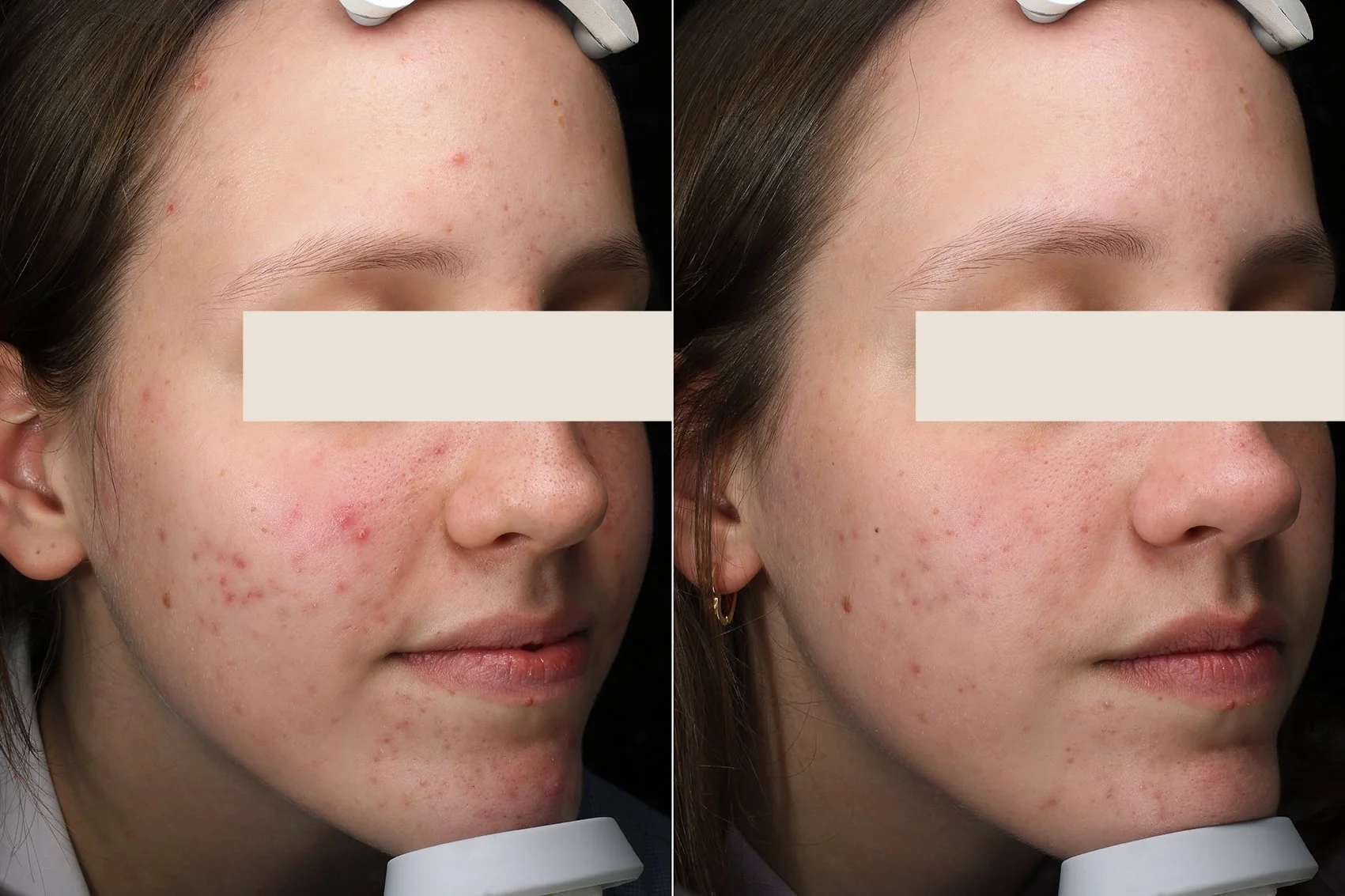 AviClear Acne treatment Northenr Sydney Derm 2 mths post AviClear 2.jpg