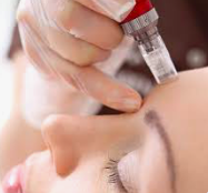 Micro Needling