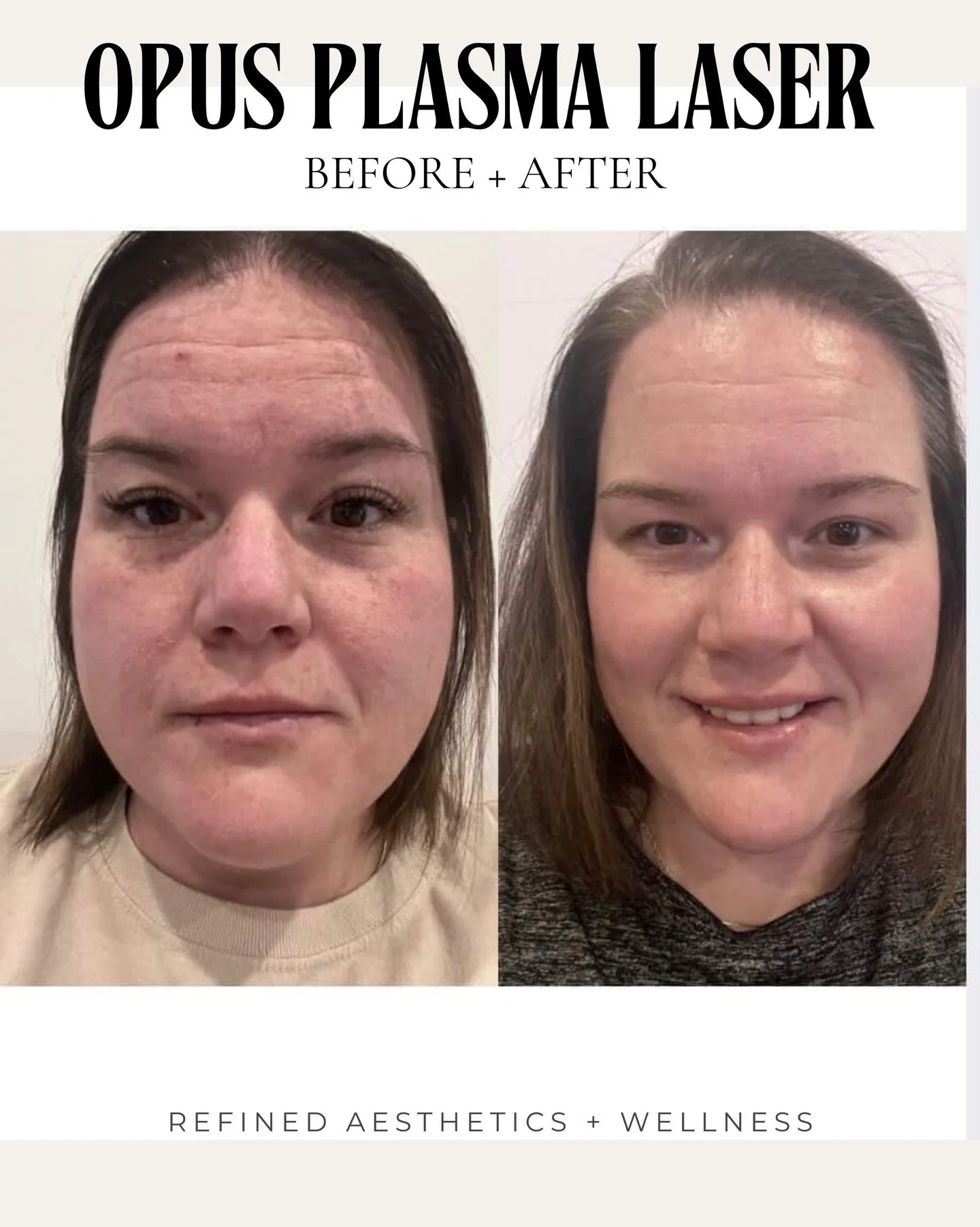We LOVE when our clients are excited about their results and send us updates! This sweet client of ours has been seeing @sknwithgracie and was started a new skin care regimen with us, had one facial and has received only ONE Opus treatment and she&rs