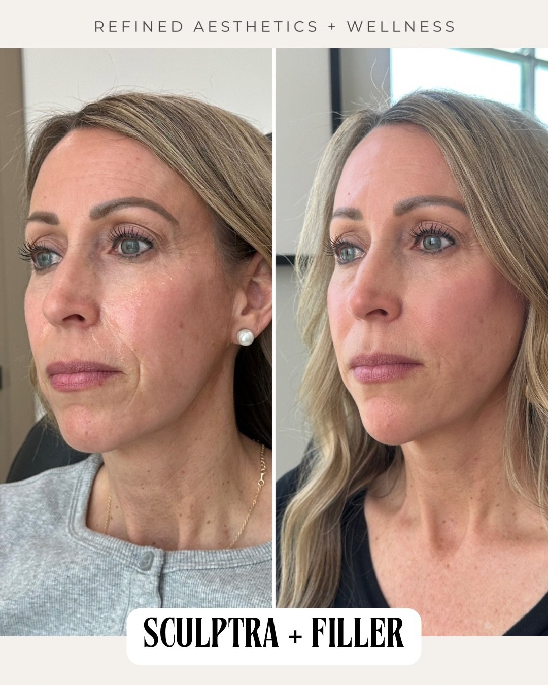 One of our stunning models from an advanced filler course from a few weeks ago! Her before picture was back in May where a series of sculptra was done over two sessions and then 3 weeks ago we did filler in her chin, jawline and in her NLF to soften 