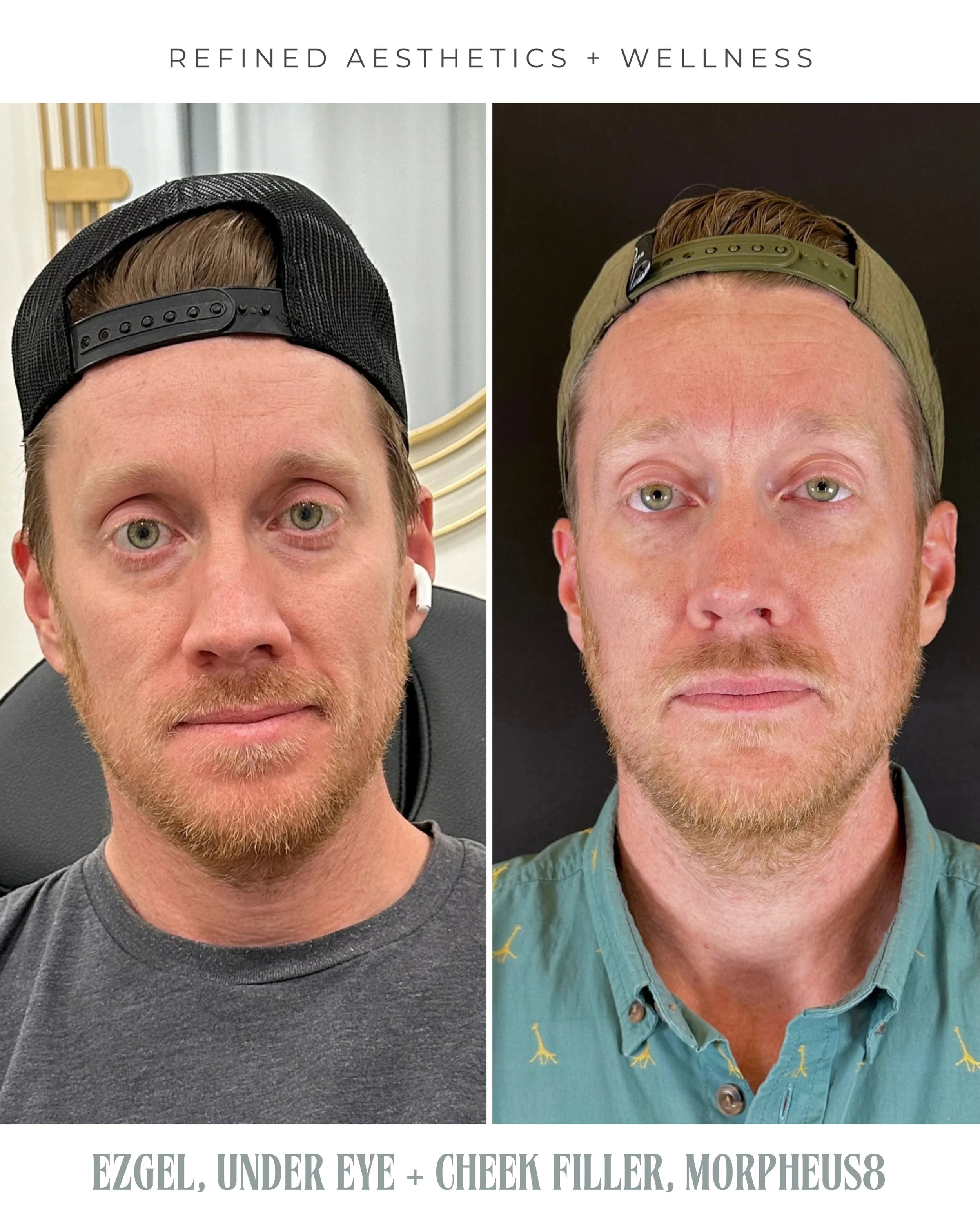UNDEREYE REJUVENATION

This undereye transformation is the result of multiple modalities and a little bit of patience. What we&rsquo;ve done 👇🏼

&bull;PRF/EZgel to help with dark circles, skin quality and slow release of healing properties to the u