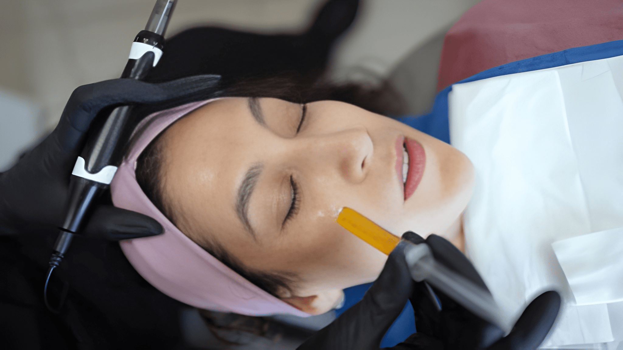 PRF Microneedling