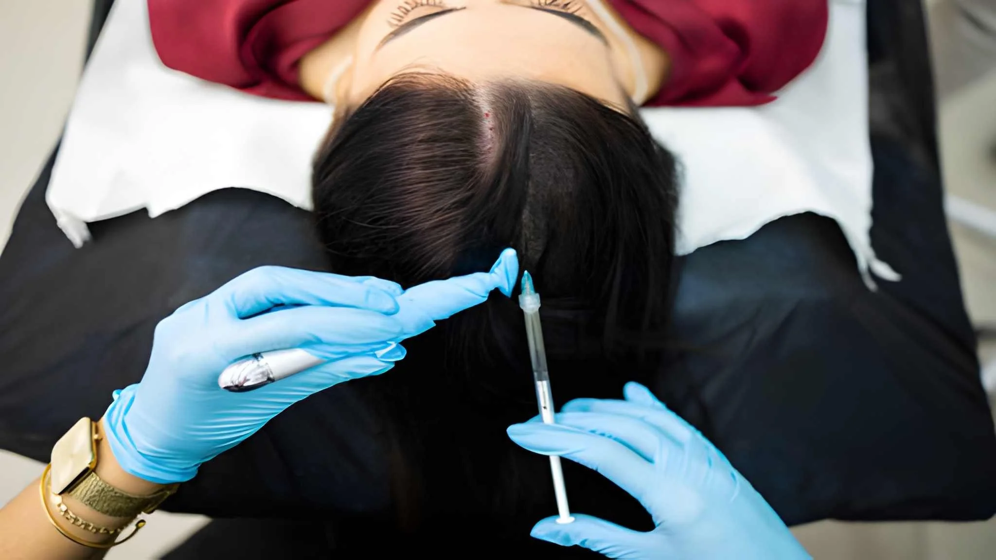 PRF Scalp Injections