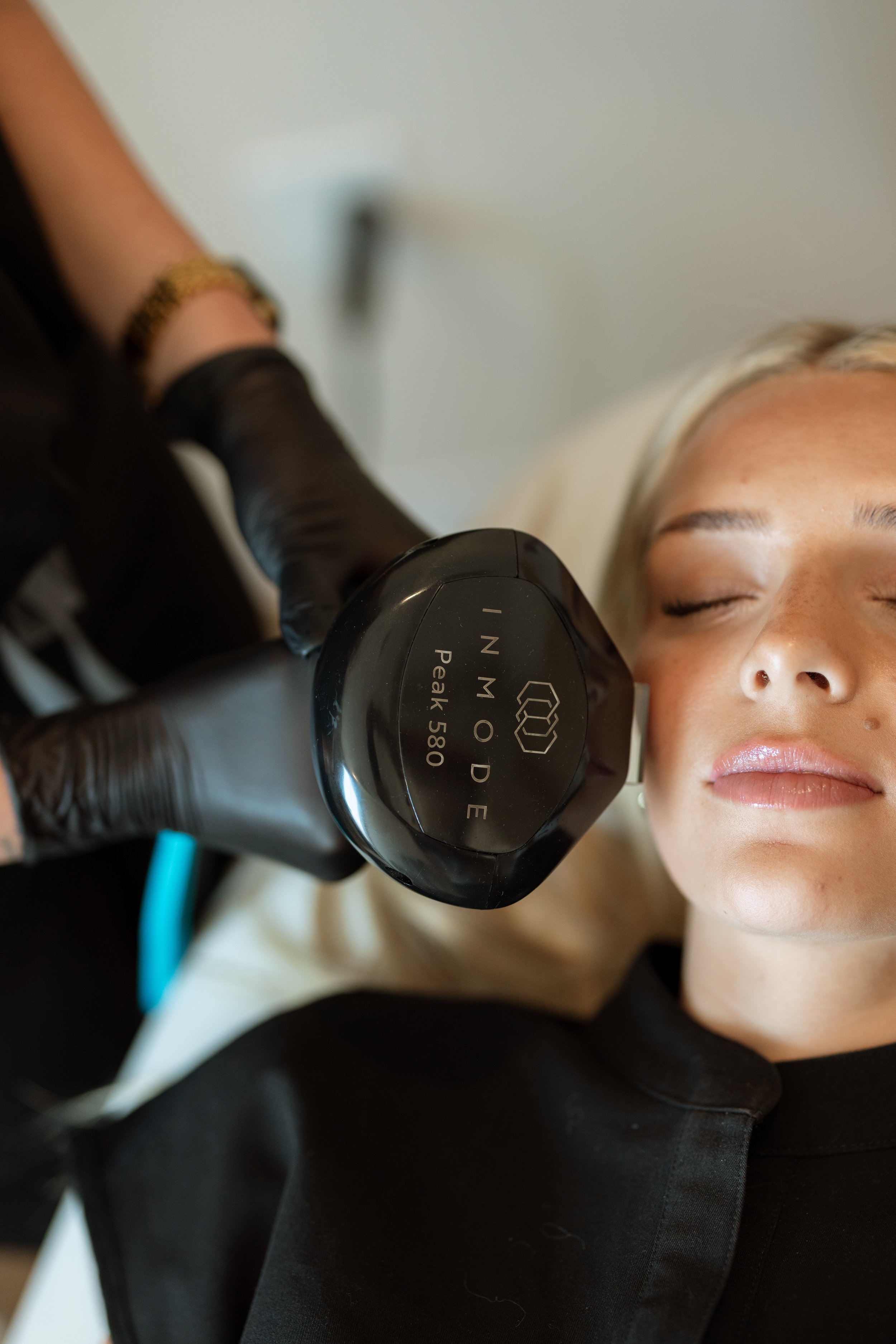 Laser skin treatments in Logan UT