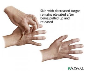 A photo of a person testing their skin turgor - pinching the back of their hand
