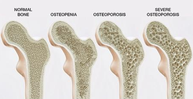 A diagram showing the differences between normal bone and osteoporotic bone, with noticeable more hollow look to the osteporotic bone