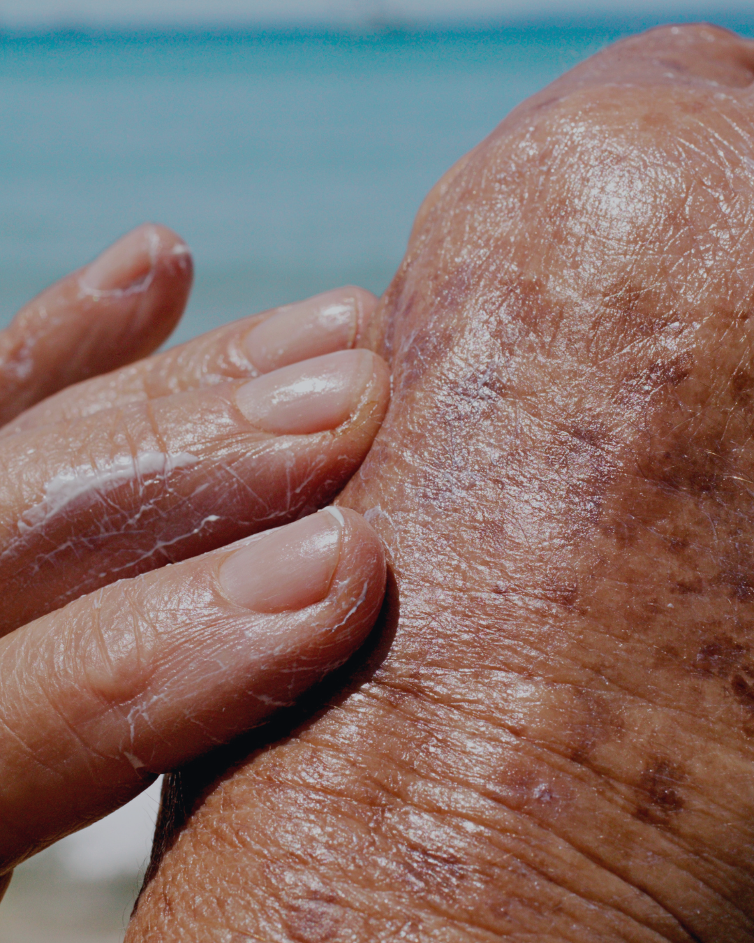 Sun Damaged Skin
