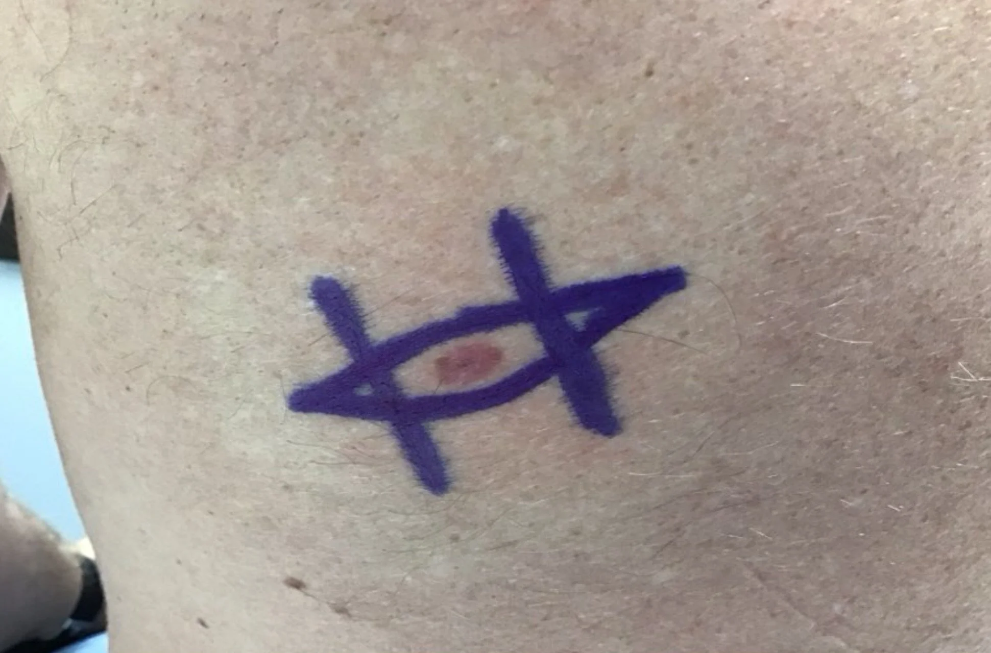 Skin Surgery in Naples Florida