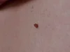 Skin Tags — Naples Dermatology
