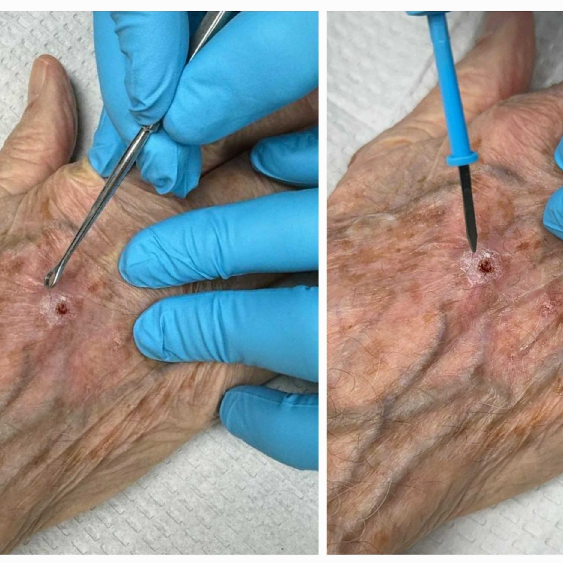 Treatment for non-melanoma skin cancers in Naples Florida