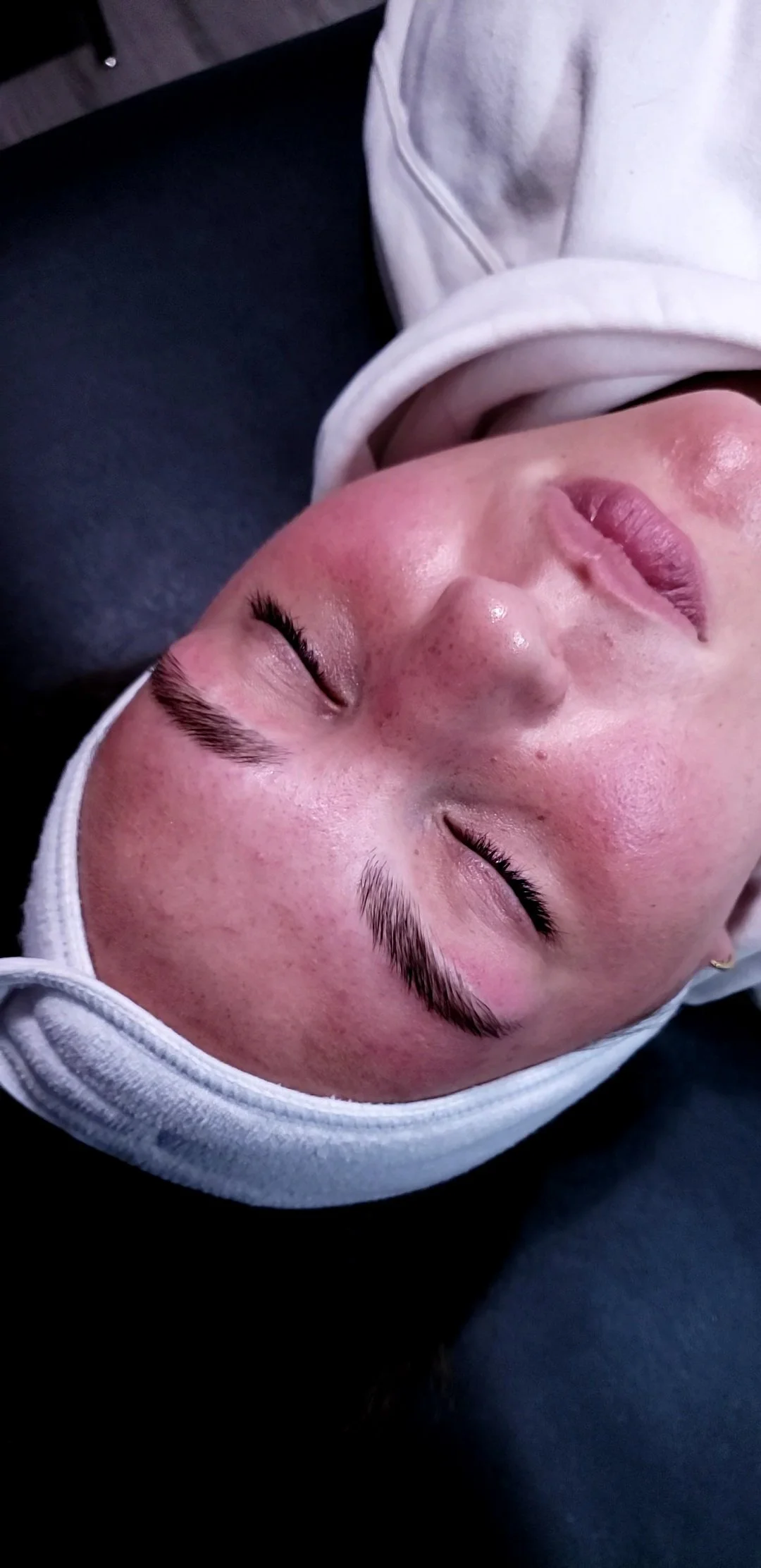 Person with red, irritated skin and closed eyes, wearing a headband, lying down.