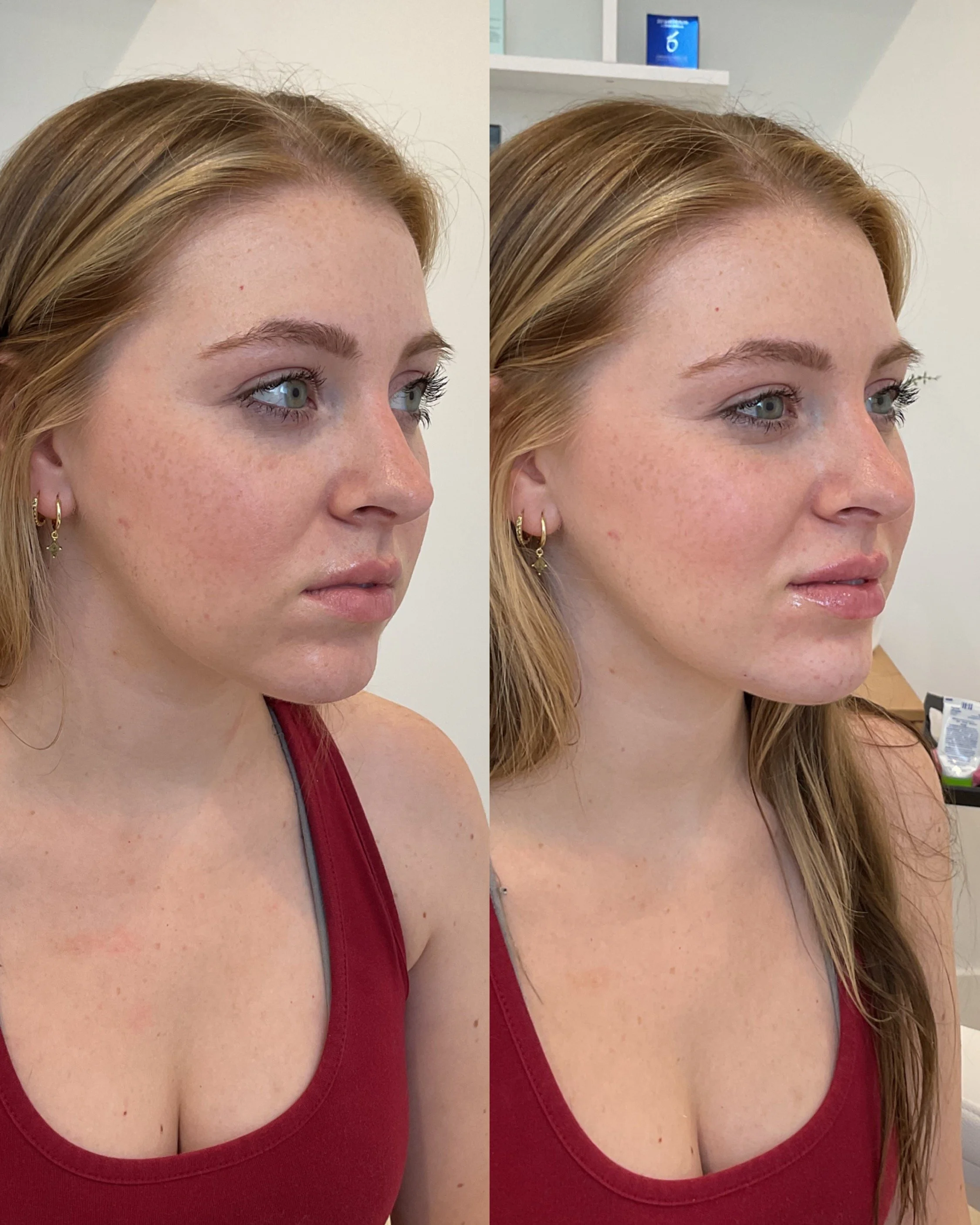 Chin & Lip Filler