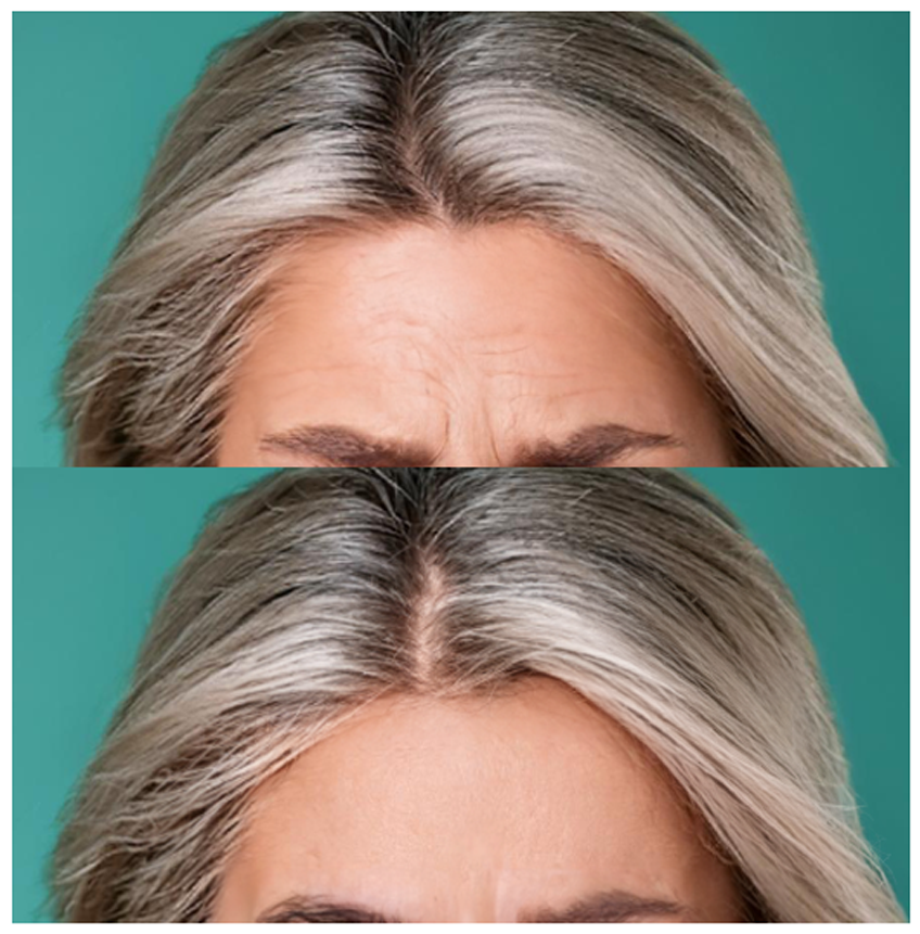 Comparison of a woman's forehead and hairline before and after hair treatment, showing reduced wrinkles and increased hair density.