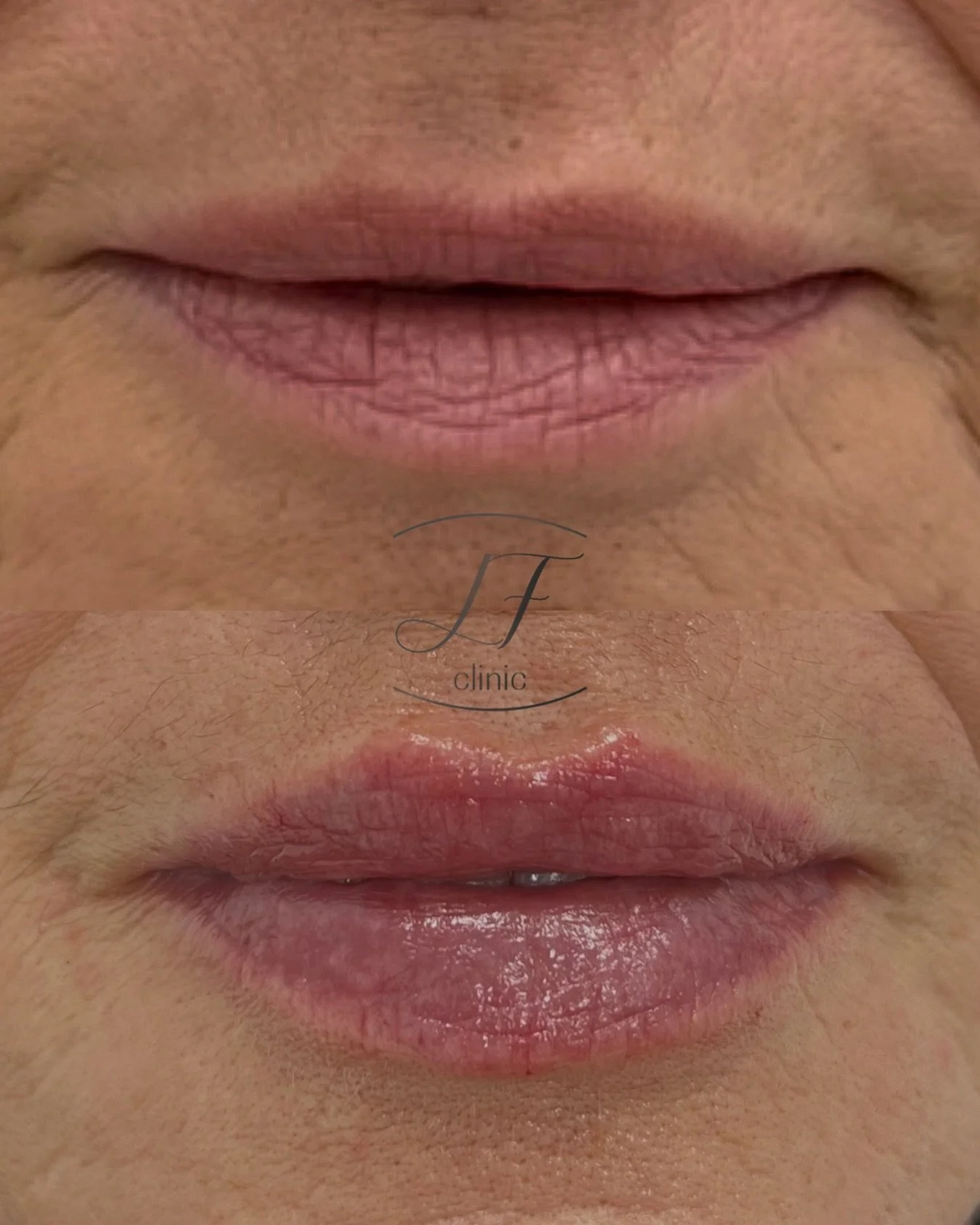 Feliz domingo soleado ☀️

Os comparto este precioso resultado de aumento y perfilado labial con &aacute;cido hialur&oacute;nico 💋

En LF Clinic apostamos por resultados naturales, mejorando hidrataci&oacute;n, definici&oacute;n y armon&iacute;a faci