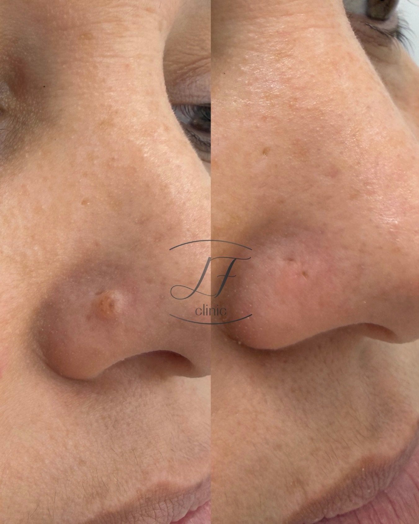 ✨ Eliminaci&oacute;n de lesiones cut&aacute;neas benignas de forma segura

En consulta realizo la eliminaci&oacute;n de lesiones cut&aacute;neas benignas, como:

✔ Fibromas blandos
✔ Queratosis seborreicas
✔ Peque&ntilde;os angiomas

Siempre bajo val