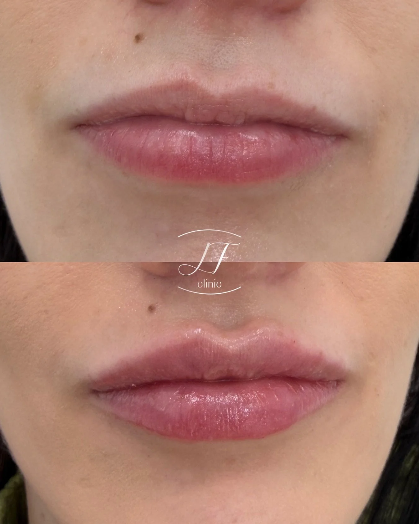 ✨ Labios naturales y definidos ✨

Aumento y perfilado labial con &aacute;cido hialur&oacute;nico para mejorar hidrataci&oacute;n, forma y armon&iacute;a, sin perder naturalidad.

✔ Definici&oacute;n
✔ Volumen suave
✔ Hidrataci&oacute;n profunda
✔ Res