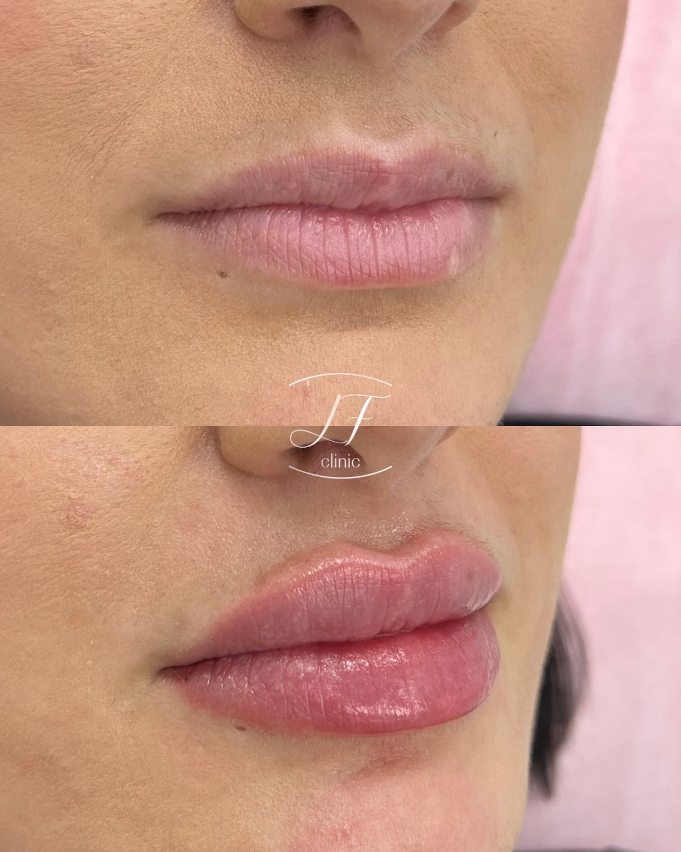 Aumento de labios con &aacute;cido hialur&oacute;nico ✨💉🫦 

Resultado de unos labios m&aacute;s hidratados, definidos y con una proyecci&oacute;n equilibrada.
 Un resultado jugoso, sim&eacute;trico y con una forma muy favorecedora para el rostro de