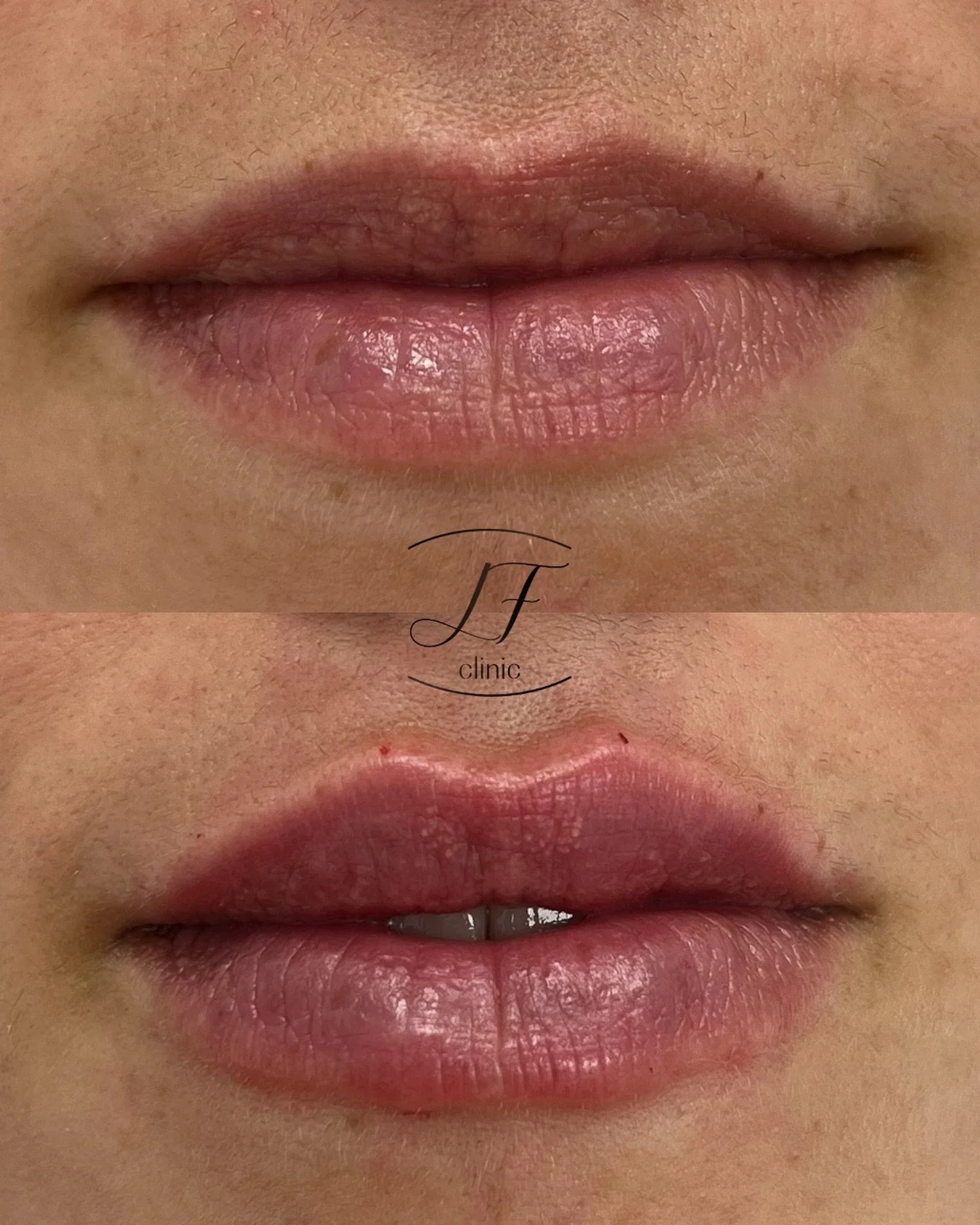 Hidrataci&oacute;n de labios 👄

✨ En LF Clinic nos encantan los resultados naturales.

💉 &iquest;Quieres presumir de labios este oto&ntilde;o? 🍂 

💕 Contacta con la cl&iacute;nica y te informaremos del procedimiento 💕

#labios #acidohialur&oacut