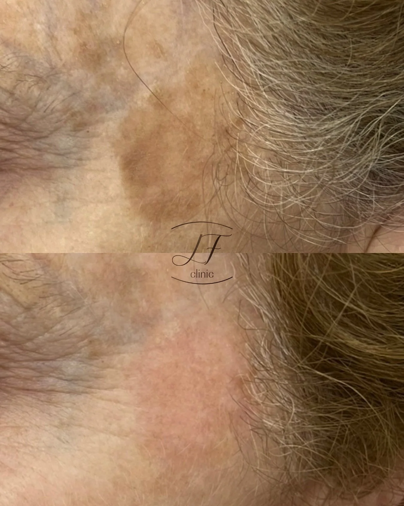 💕 Elimina tus manchas con l&aacute;ser 💕

✨ La tecnolog&iacute;a l&aacute;ser se ha consolidado como uno de los tratamientos m&aacute;s efectivos para la correcci&oacute;n de lesiones pigmentarias benignas, como lentigos solares, manchas seniles y 