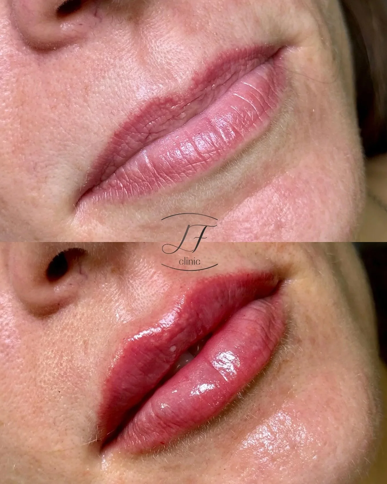 Labios con un toque IDEAL ✨💖

&iquest;Quieres unos labios hidratados y con forma? LF Clinic es tu sitio!! 👄

🍂🌳 Pide tu cita y consulta tus dudas, y luce guapa y radiante este oto&ntilde;o.

#labios #hidratacion #acidohialur&oacute;nico #pamplona