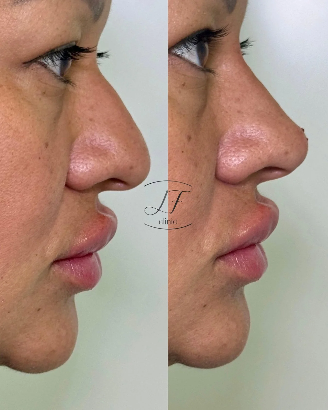 &iquest;Quieres mejorar tu perfil? 💖

Resultado ideal ✨💉

Un tratamiento no quir&uacute;rgico que corrige peque&ntilde;as imperfecciones de la nariz con resultados inmediatos y naturales.

✔️ Moldea el perfil
✔️ Disimula gibas
✔️ Levanta la punta


