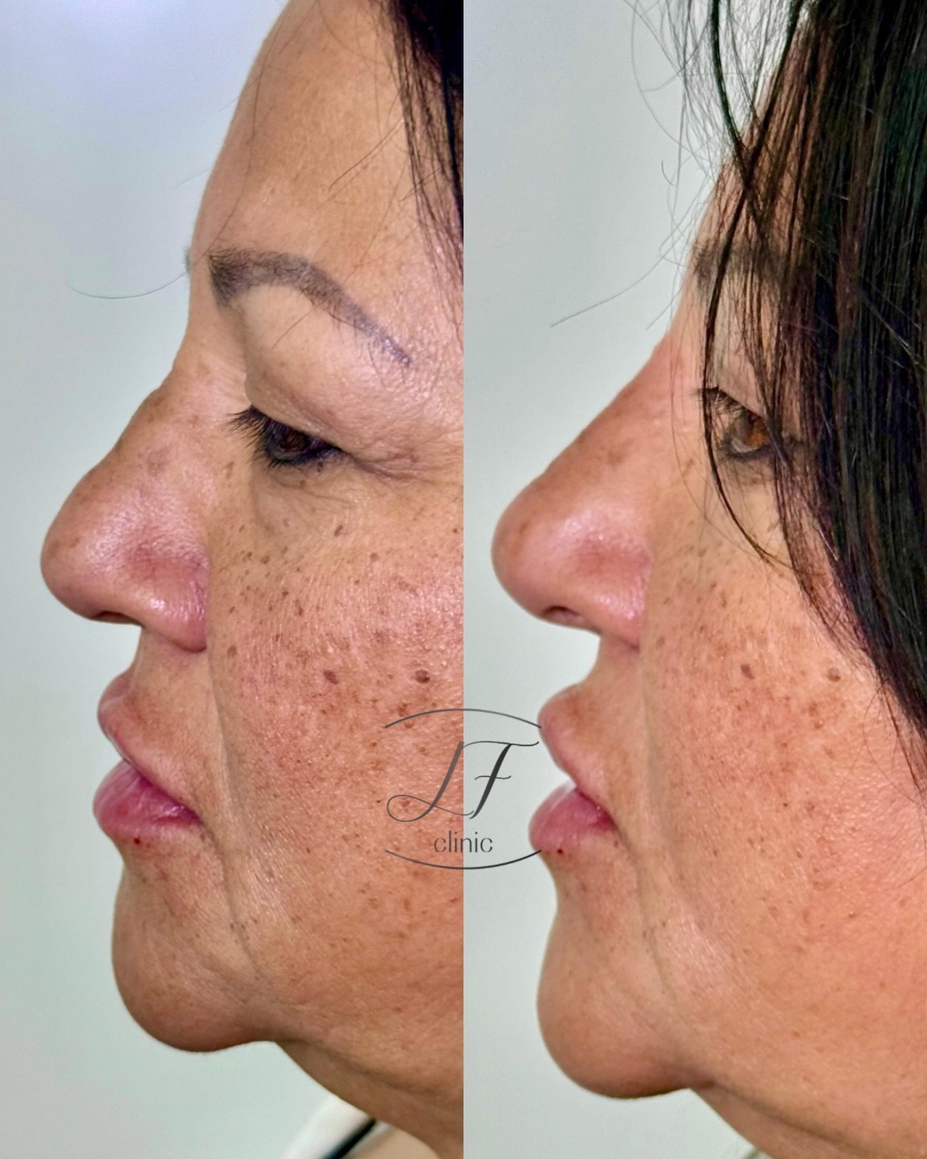 Rinomodelaci&oacute;n sin cirug&iacute;a ✨

Peque&ntilde;os cambios que armonizan el perfil y realzan la belleza natural. En esta sesi&oacute;n conseguimos una nariz m&aacute;s equilibrada y un resultado elegante, siempre respetando la esencia del ro
