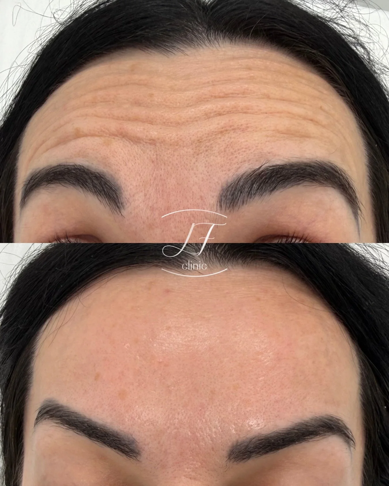 Neuromoduladores con el Dr. &Aacute;lvarez, resultados para suavizar l&iacute;neas de expresi&oacute;n din&aacute;micas y est&aacute;ticas en la frente, conservando naturalidad y armon&iacute;a facial. 🌸

Tratamiento personalizado, m&iacute;nimament
