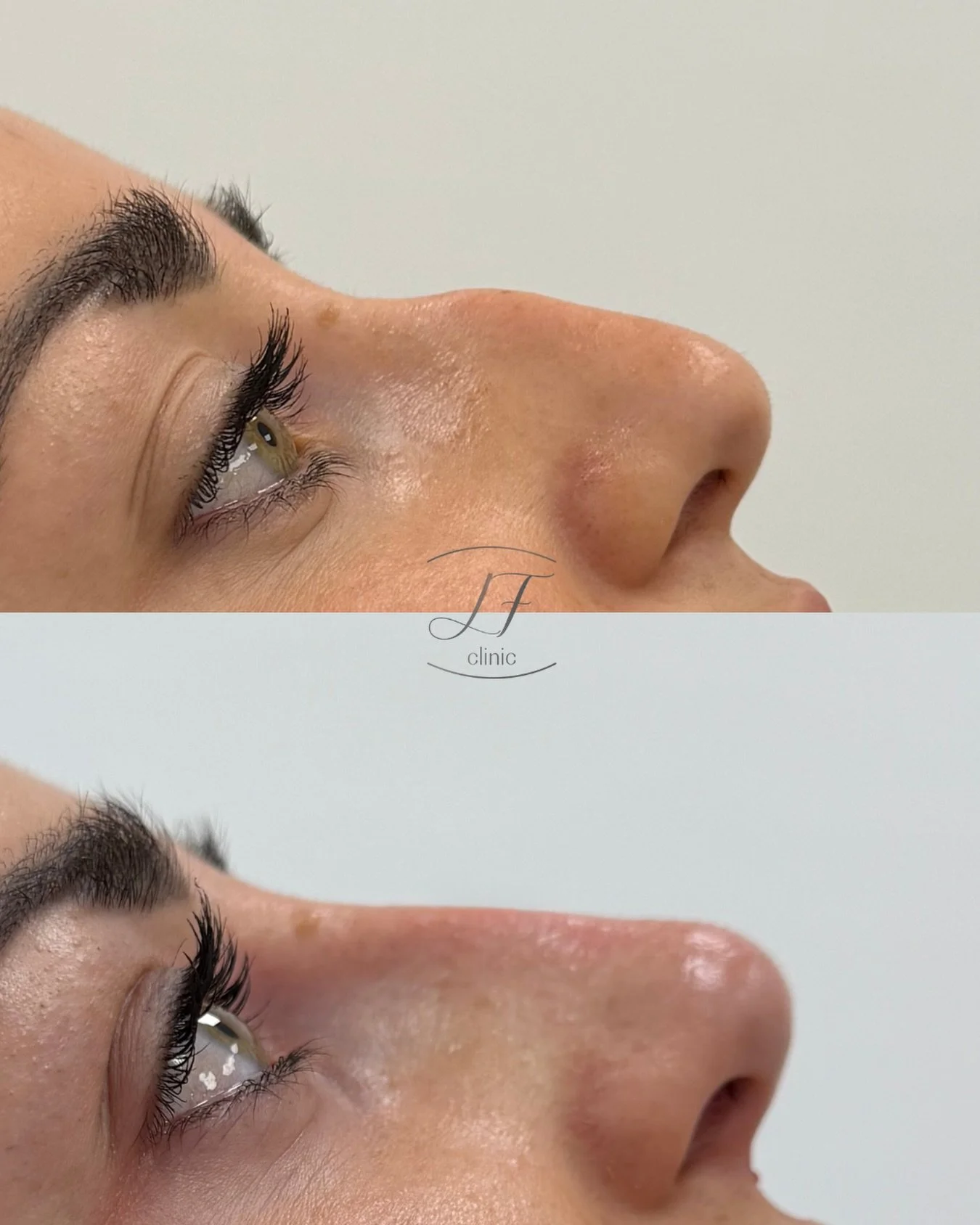 ✨ Peque&ntilde;os cambios, grandes diferencias.

Rinomodelaci&oacute;n con &aacute;cido hialur&oacute;nico para armonizar el perfil, suavizar irregularidades y conseguir una nariz visualmente m&aacute;s equilibrada, respetando siempre los rasgos natu
