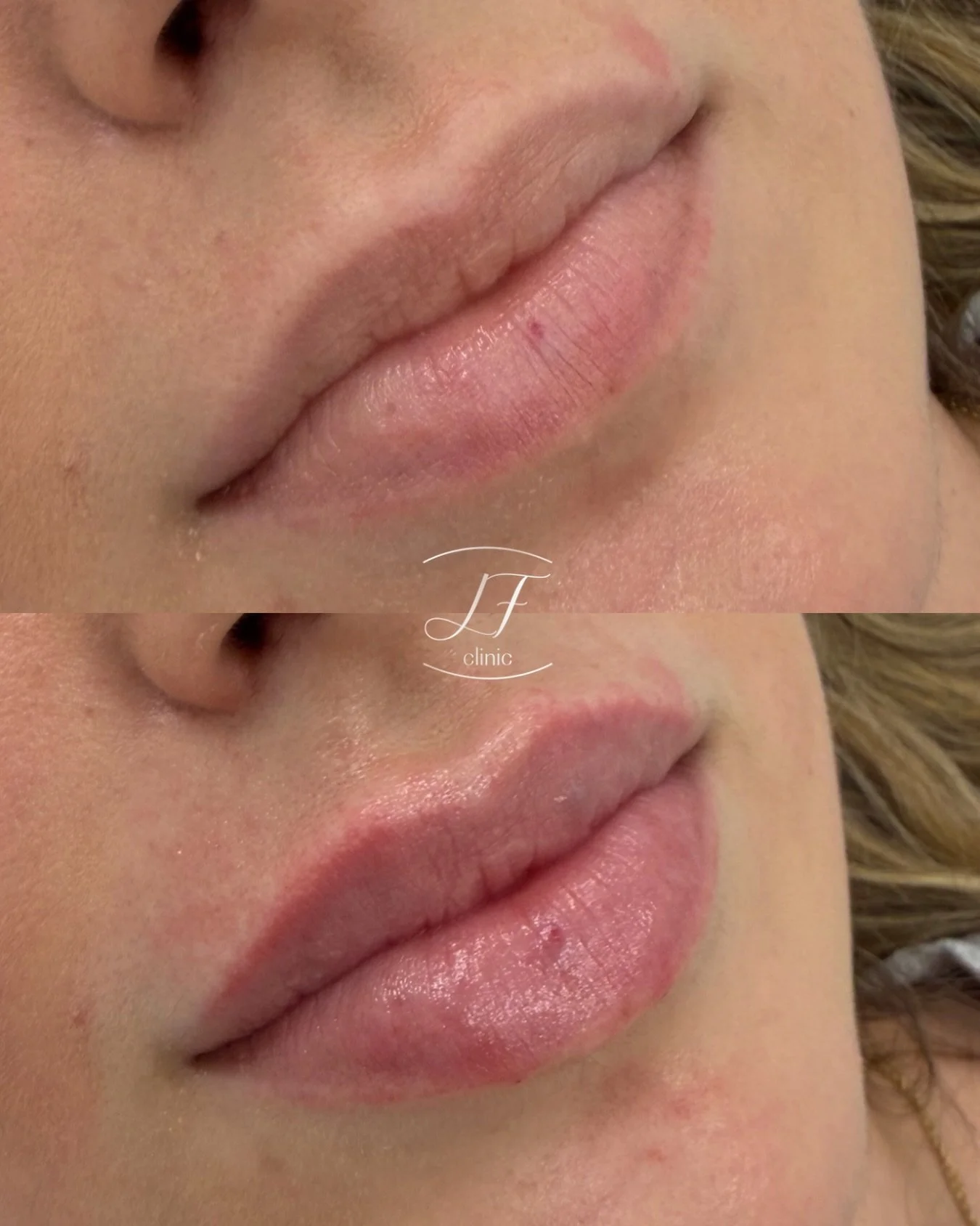 Tu esencia, tus labios, tu mejor versi&oacute;n 💋

📍 LF Clinic &middot; Pamplona
📩 Citas y valoraci&oacute;n por mensaje privado

#labios #&aacute;cidohialur&oacute;nico #labioshidratados #pamplona #pamplonairu&ntilde;a