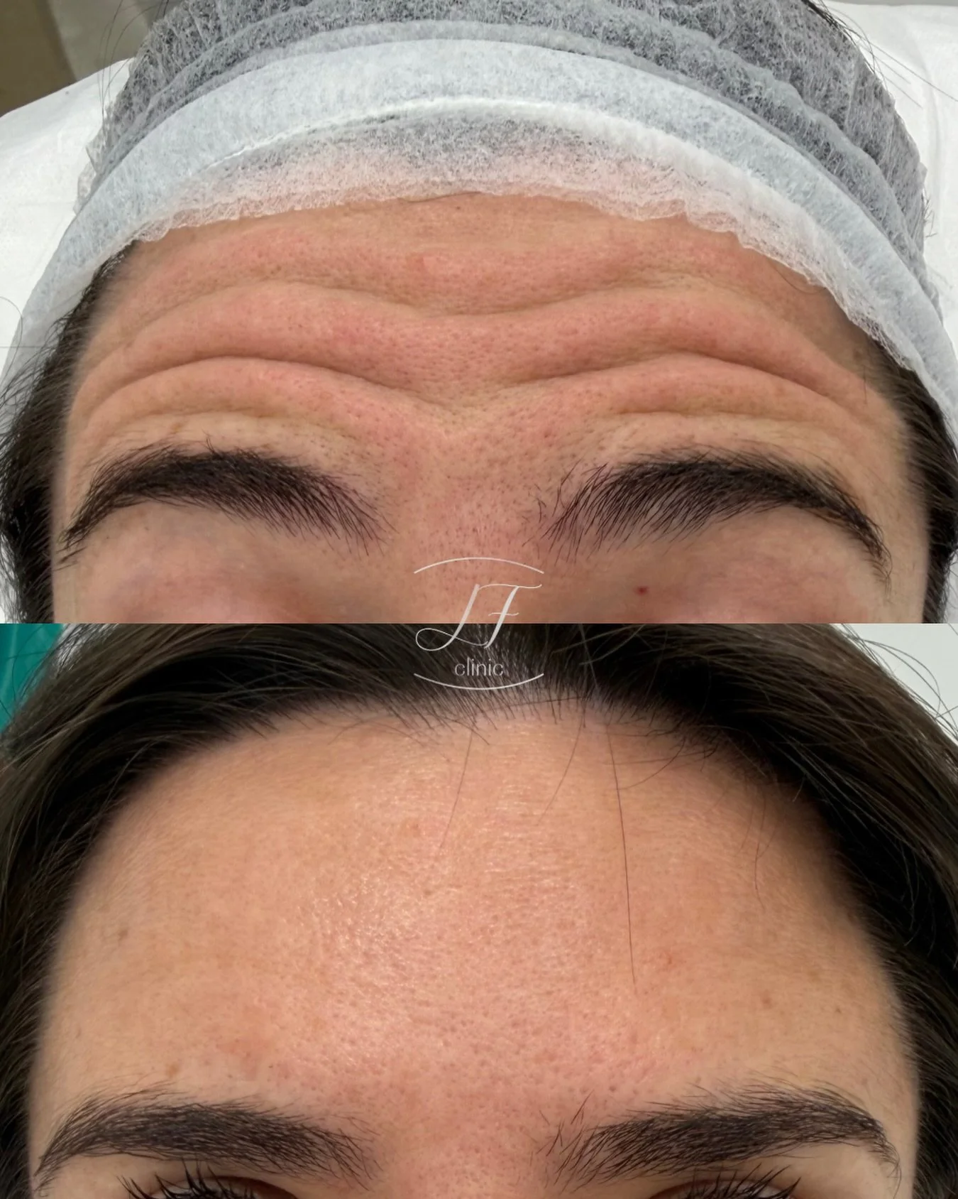 ✨ Un resultado que habla por s&iacute; solo.

Tratamiento enfocado en suavizar las l&iacute;neas de expresi&oacute;n de la frente, manteniendo un resultado natural y arm&oacute;nico.

El objetivo no es cambiar la expresi&oacute;n, sino conseguir un a