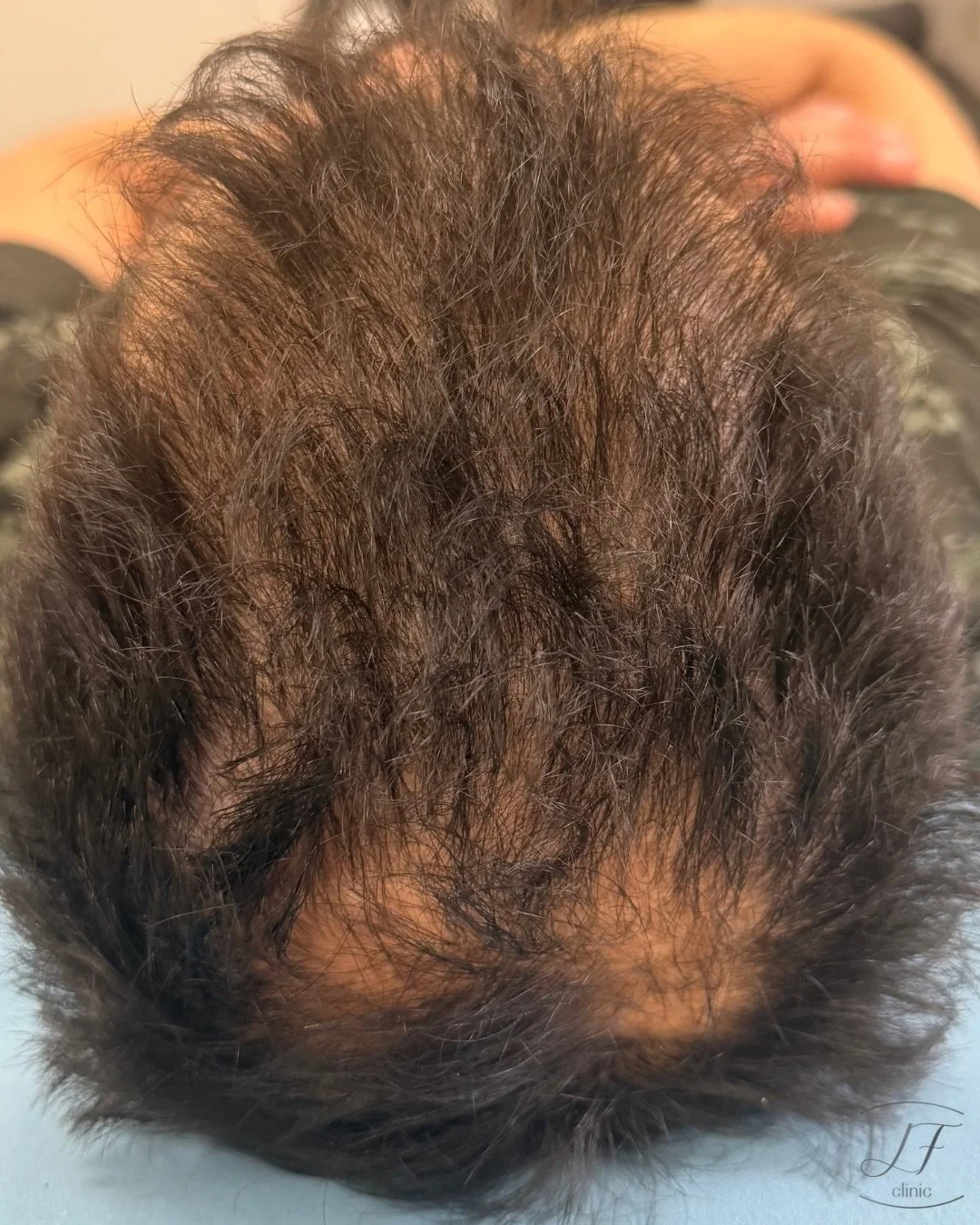 ✨ EVOLUCI&Oacute;N CAPILAR

ANTES ➡️➡️ DESPU&Eacute;S

Cuando hablamos de tratamientos capilares, el objetivo no es solo frenar la ca&iacute;da: buscamos mejorar la calidad del cabello, estimular el fol&iacute;culo y recuperar progresivamente la dens