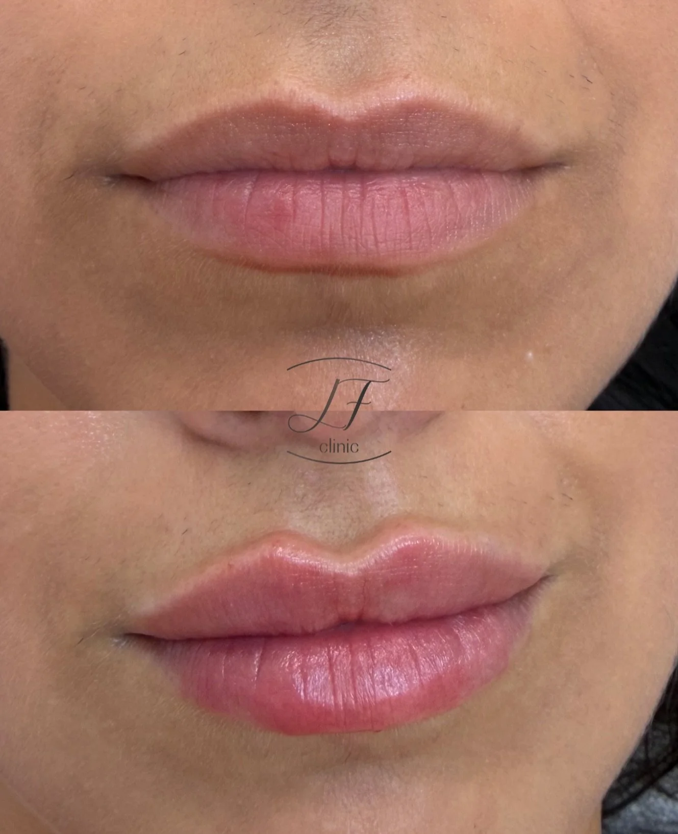 ✨ Unos labios bonitos no tienen por qu&eacute; perder su naturalidad.

En este caso hemos aportado hidrataci&oacute;n, definici&oacute;n y un volumen sutil, respetando la forma original de los labios.

El objetivo siempre es el mismo: realzar, no tra