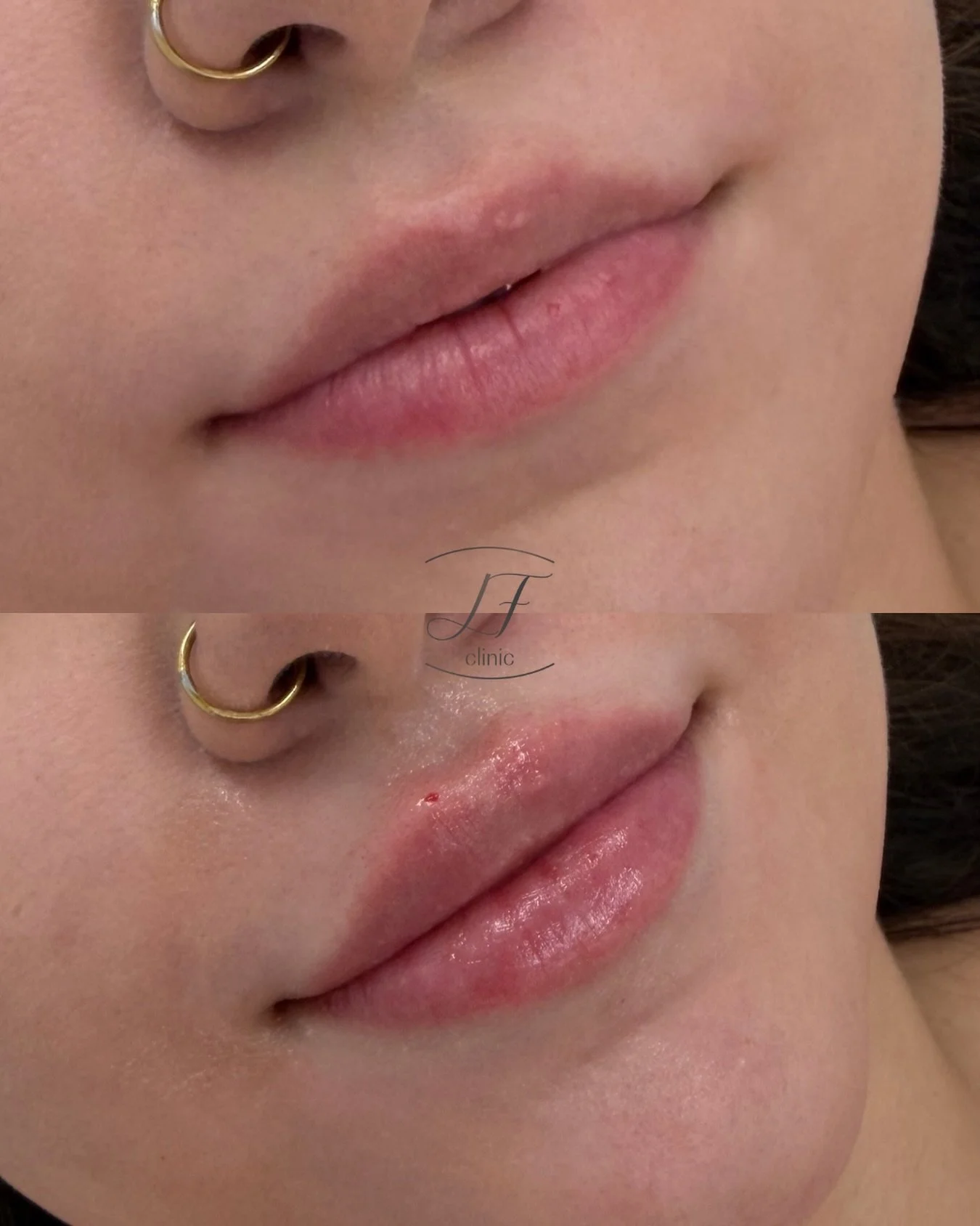 💋 Lunes de labios

Hidrataci&oacute;n, definici&oacute;n y volumen con &aacute;cido hialur&oacute;nico, siempre buscando un resultado natural y en armon&iacute;a con tus facciones. ✨

📍 LF Clinic - Av. Sancho el Fuerte 6, Pamplona 

#labios #acidoh