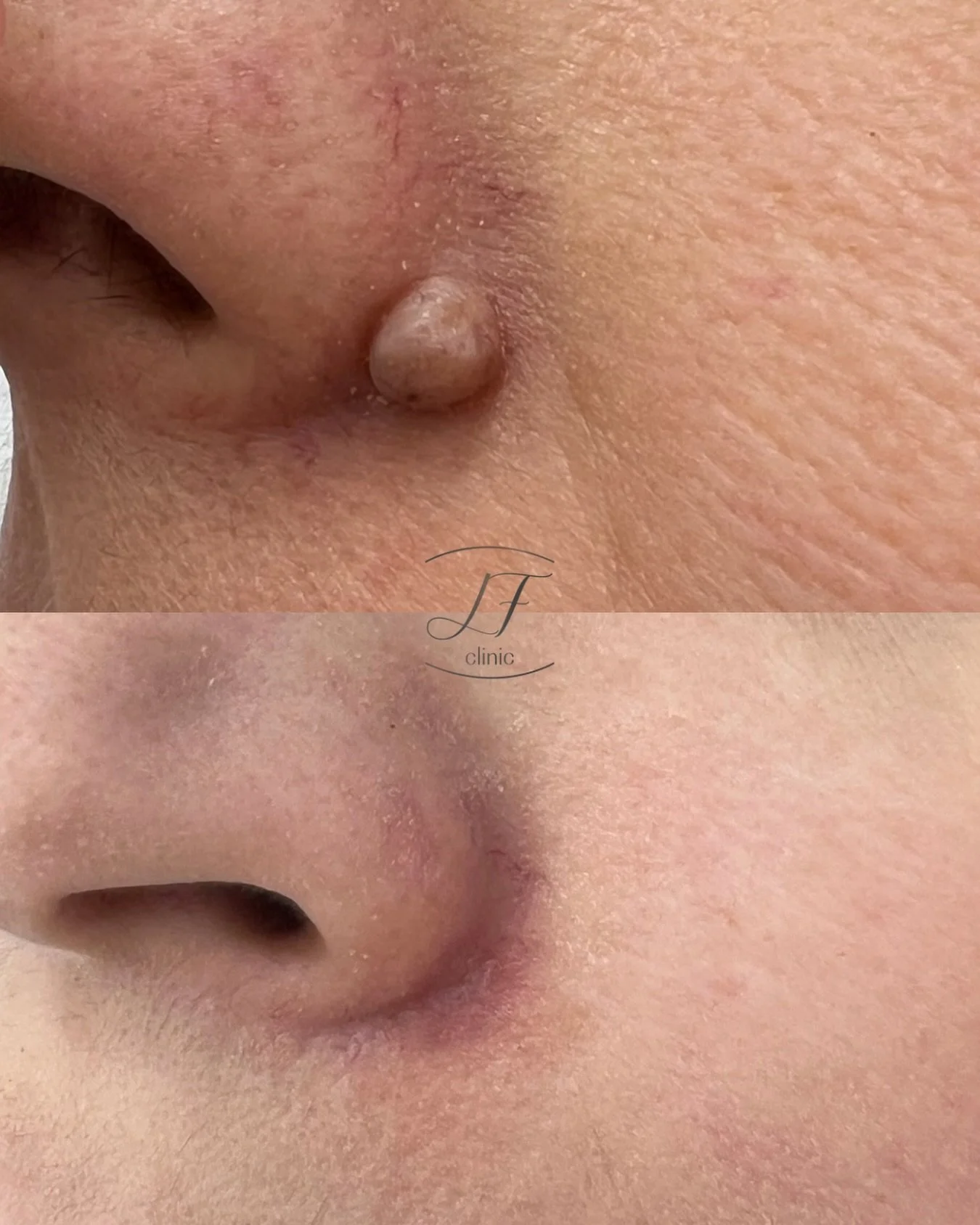 ✨ &iexcl;Peque&ntilde;os detalles, grandes cambios!

En LF Clinic tratamos lesiones cut&aacute;neas benignas como verrugas, acrocordones, queratosis seborreicas y puntos rub&iacute;.

🤍 Tratamientos personalizados, previa valoraci&oacute;n de la les