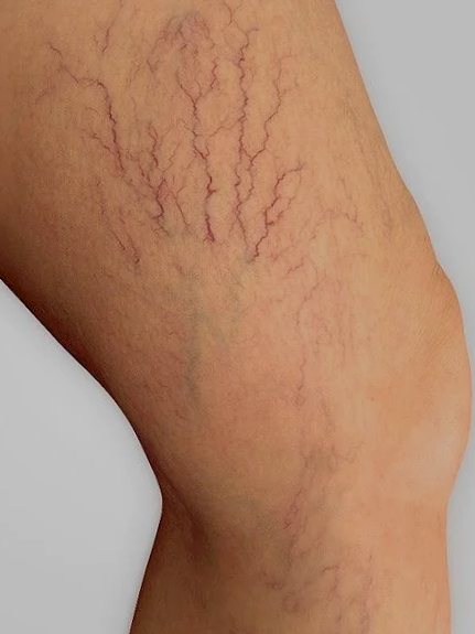 Venas varicosas en la parte posterior de la pierna.